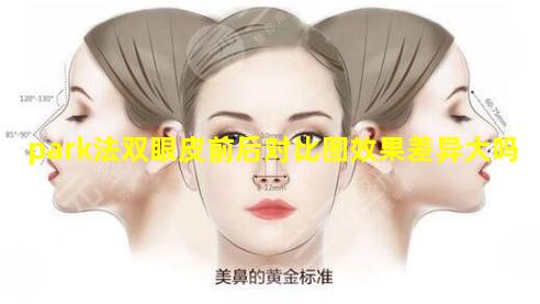 park法双眼皮前后对比图效果差异大吗