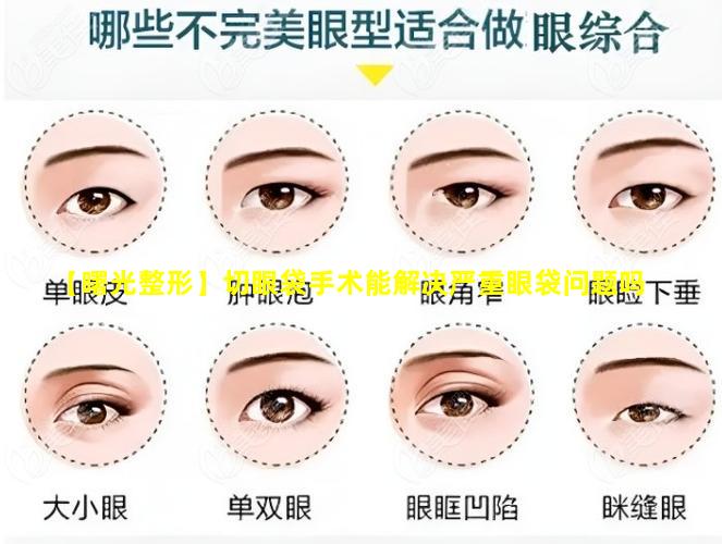 【曙光整形】切眼袋手术能解决严重眼袋问题吗