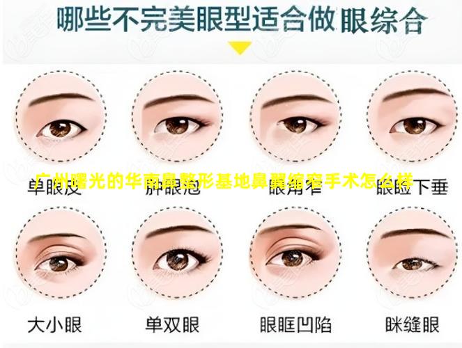 广州曙光的华南鼻整形基地鼻翼缩窄手术怎么样
