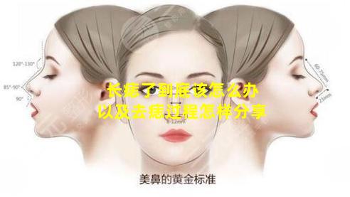 长痣了到底该怎么办以及去痣过程怎样分享